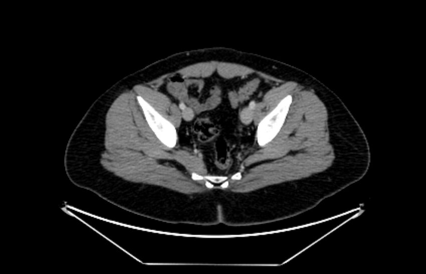 Adrenocortical carcinoma (Radiopaedia 80134-93438 Axial C+ portal venous phase 114).jpg