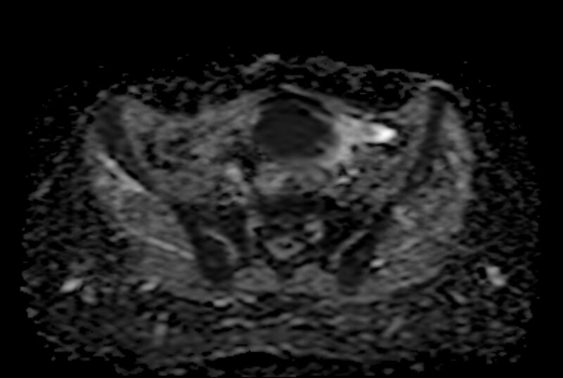 File:Adult granulosa cell tumor of the ovary (Radiopaedia 71581-81950 Axial ADC 9).jpg