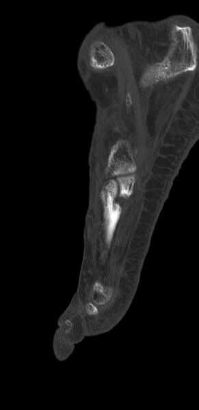 File:Advanced osteomyelitis due to open metatarsal fracture (Radiopaedia 83891-99095 C 18).jpg