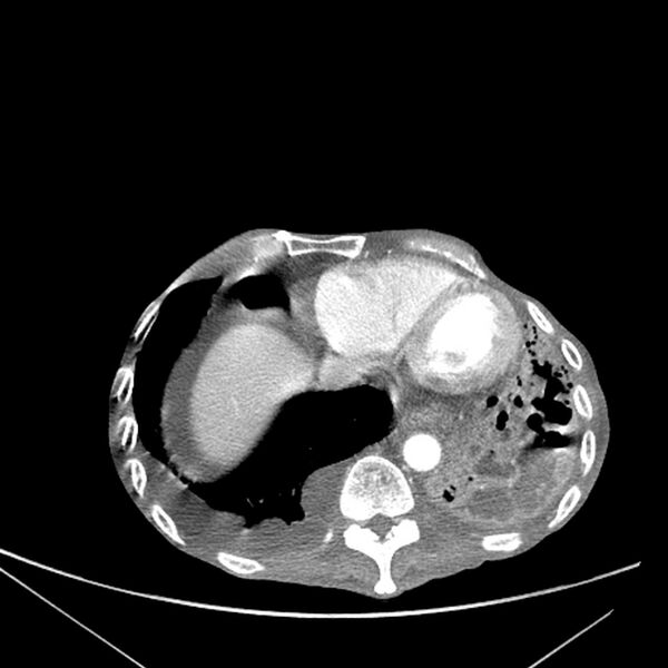 File:Advanced pulmonary tuberculosis (Radiopaedia 8599-9431 Axial liver window 15).jpg