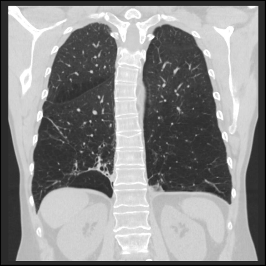 Alpha-1-antitrypsin deficiency (Radiopaedia 40993-43722 Coronal lung window 77).jpg