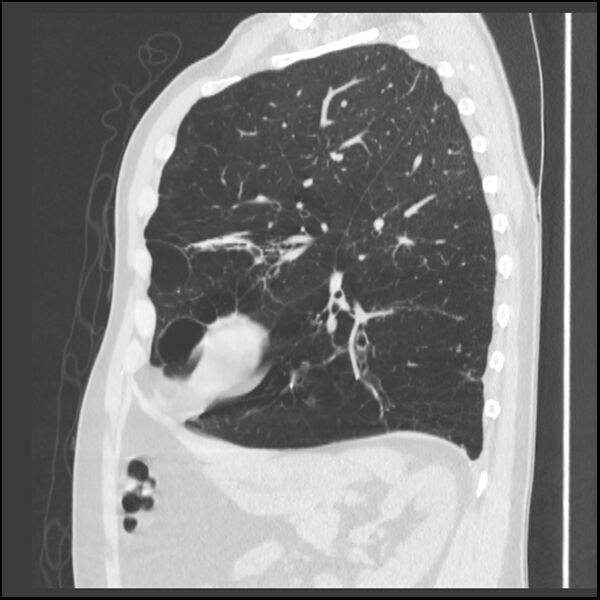 File:Alpha-1-antitrypsin deficiency (Radiopaedia 40993-43722 Sagittal lung window 84).jpg