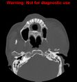 Ameloblastoma (Radiopaedia 13276-13280 Axial non-contrast 18).jpg