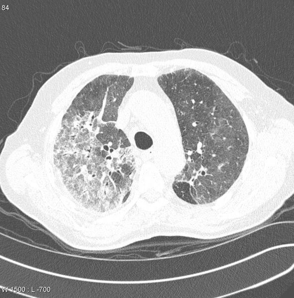 File:Amiodarone lung (Radiopaedia 6539-7851 Axial lung window 8).jpg
