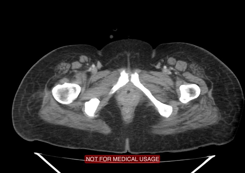 File:Amoebic enterocolitis with liver abscess (Radiopaedia 35100-36609 A 85).jpg
