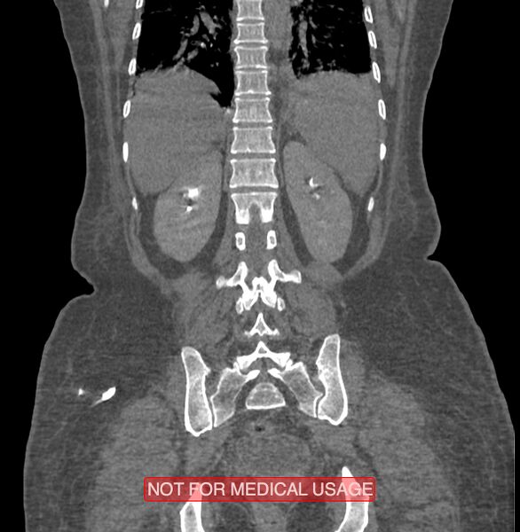 File:Amoebic enterocolitis with liver abscess (Radiopaedia 35100-36609 B 154).jpg