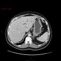 Ampullary carcinoma (Radiopaedia 56396-63056 C 22).jpg