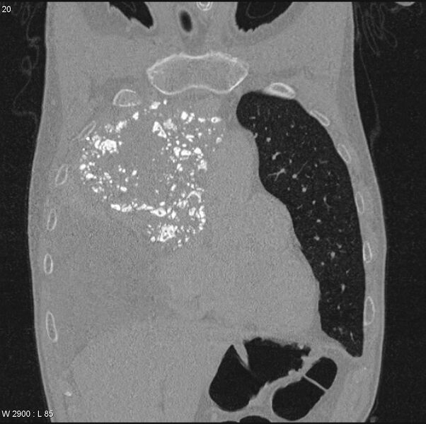 File:Amyloidoma - mediastinal (Radiopaedia 6711-7925 Coronal bone window 3).jpg