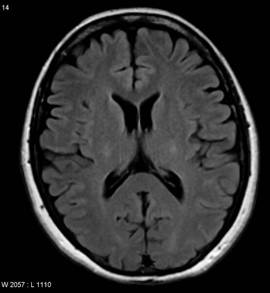 File:Amyotrophic lateral sclerosis (Radiopaedia 5373-7134 Axial FLAIR 14).jpg