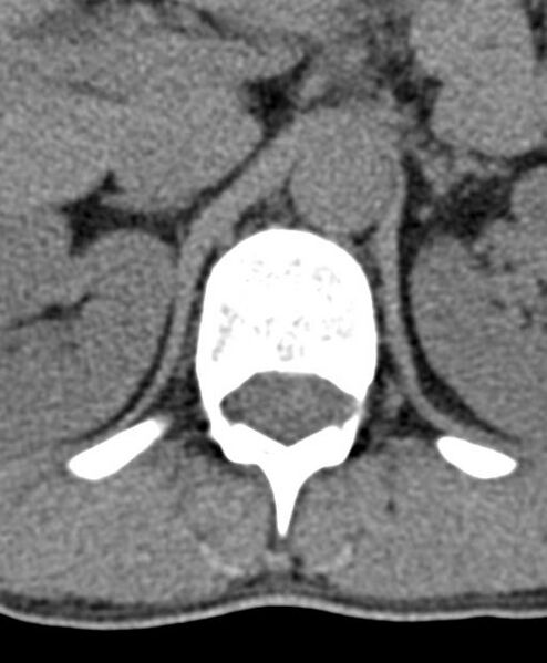 File:Aneurysmal bone cyst T11 (Radiopaedia 29294-29721 Axial non-contrast 55).jpg