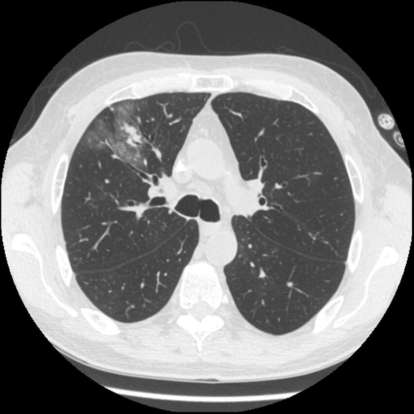 Angioinvasive aspergillosis (Radiopaedia 43957-47466 Axial lung window 26).jpg