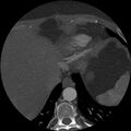 Anomalous origin of left circumflex artery from right coronary sinus (Radiopaedia 72563-83117 A 4).jpg