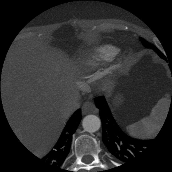 File:Anomalous origin of left circumflex artery from right coronary sinus (Radiopaedia 72563-83117 A 4).jpg