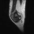 Anterior cruciate ligament tear - pediatric (Radiopaedia 62152-70260 Sagittal PD 22).jpg