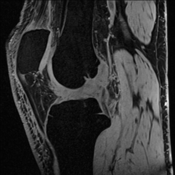 File:Anterior cruciate ligament tear - ramp lesion (Radiopaedia 71883-82322 Sagittal T1 vibe 74).jpg