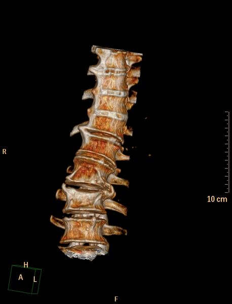 File:Anterior vertebral scalloping (abdominal aortic aneurysm) (Radiopaedia 66744-76067 A 4).jpg