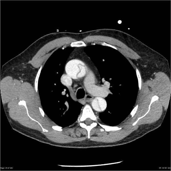 File:Aortic dissection- Stanford A (Radiopaedia 37759-39664 A 20).jpg