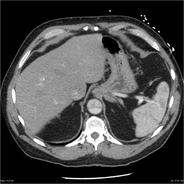 File:Aortic dissection- Stanford A (Radiopaedia 37759-39664 A 65).jpg