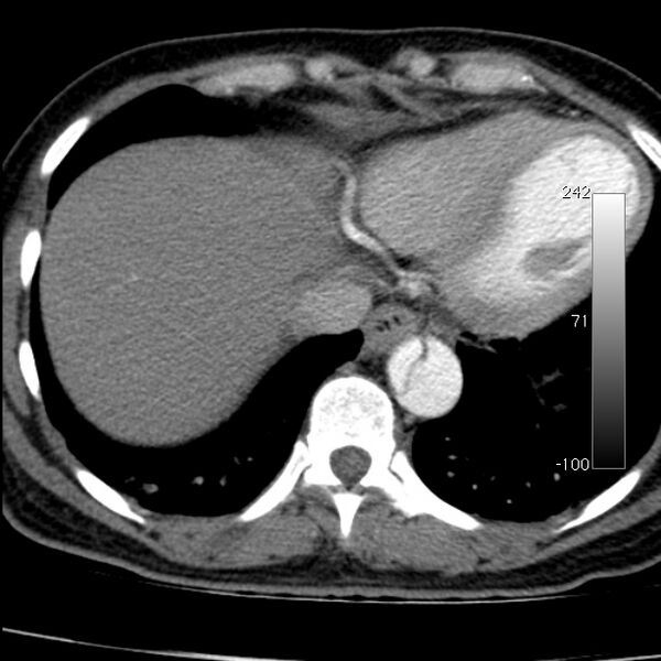 File:Aortic dissection - Stanford type A (Radiopaedia 29247-29659 A 61).jpg