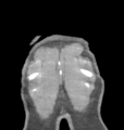 Aortic valve non-coronary cusp thrombus (Radiopaedia 55661-62189 C 78).png