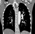Aortopulmonary window, interrupted aortic arch and large PDA giving the descending aorta (Radiopaedia 35573-37074 D 50).jpg
