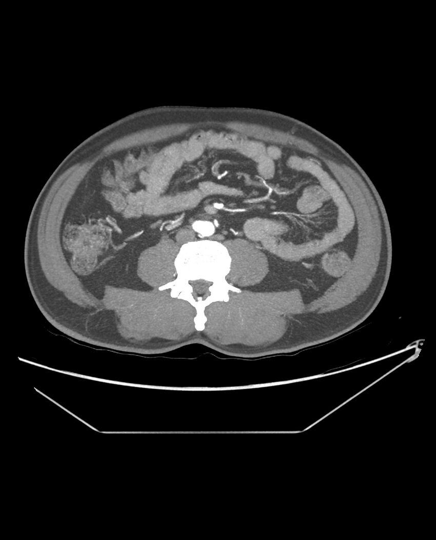 Aplastic posterior tibial arteries (Radiopaedia 84021-99249 A 65).jpg