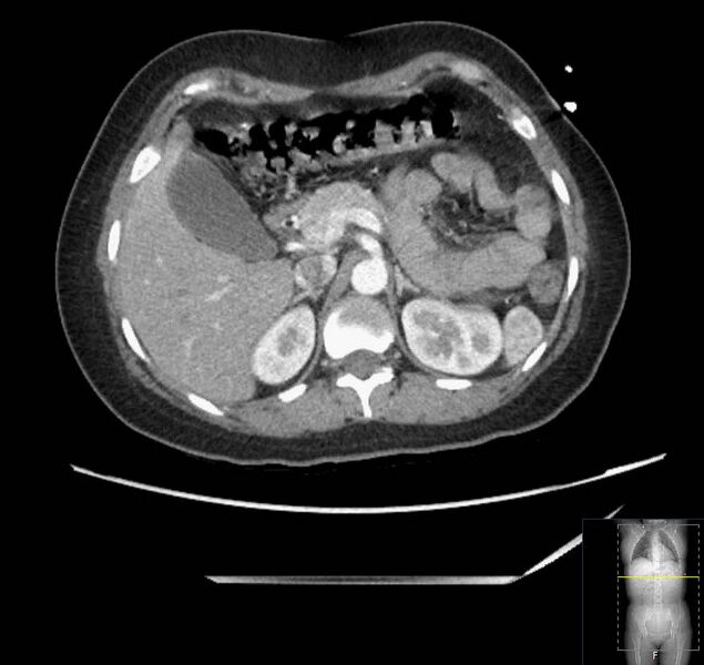 File:Appendicitis (CT angiogram) (Radiopaedia 154713-127660 Axial 145).jpg