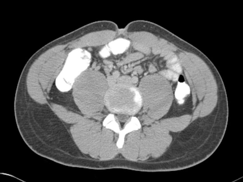 Appendicitis and incidental foregut duplication cyst (Radiopaedia 52962-58916 A 51).jpg