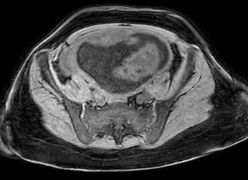 File:Appendicitis in gravida (MRI) (Radiopaedia 89433-106395 Axial DIXON 110).jpg