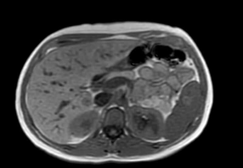 File:Appendicitis in gravida (MRI) (Radiopaedia 89433-106395 Axial T1 in-phase 16).jpg
