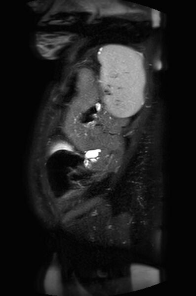 File:Appendicitis in gravida (MRI) (Radiopaedia 89433-106395 Sagittal T2 SPAIR 9).jpg