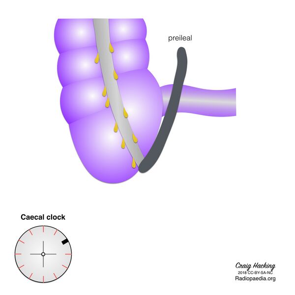 File:Appendix position (diagram) (Radiopaedia 62911-71293 C 2).jpeg