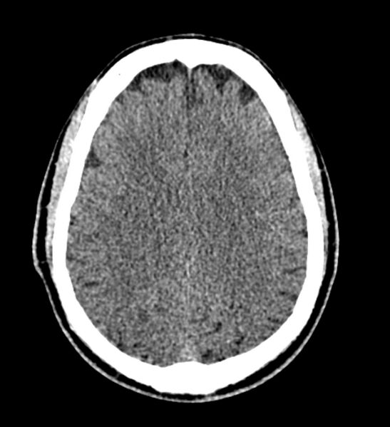 File:Arachnoid cyst of the ambient cistern (Radiopaedia 81301-94986 Axial non-contrast 47).jpg
