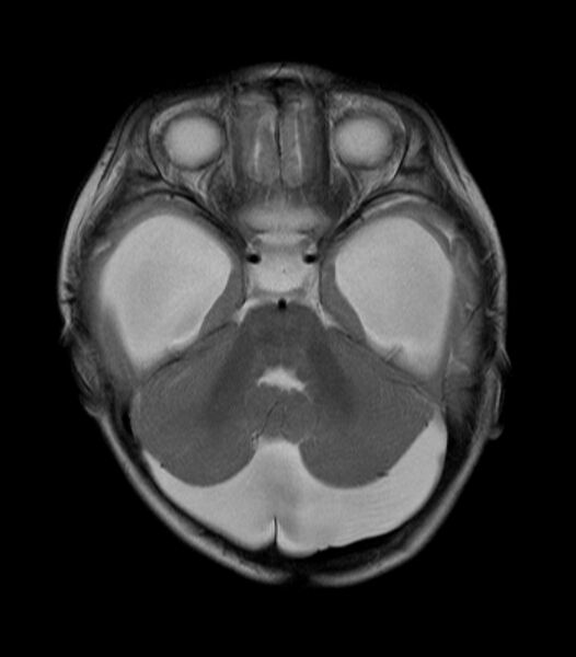 File:Arachnoid cyst of the posterior fossa with hydrocephalus (Radiopaedia 5682-7389 Axial T2 1).jpg