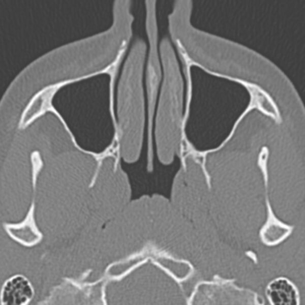 File:Arrested pneumatization of the sphenoid (Radiopaedia 10700-11172 Axial non-contrast 15).jpg