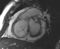 Arrhythmogenic right ventricular cardiomyopathy (Radiopaedia 69431-79307 Short axis cine 186).jpg