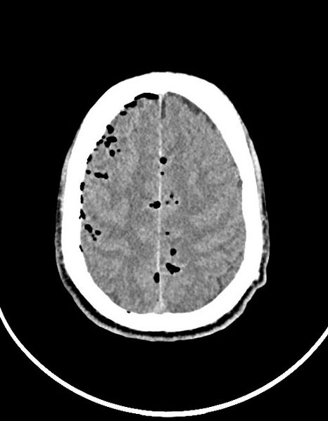 File:Arrow injury to the brain (Radiopaedia 72101-82607 Axial non-contrast 84).jpg