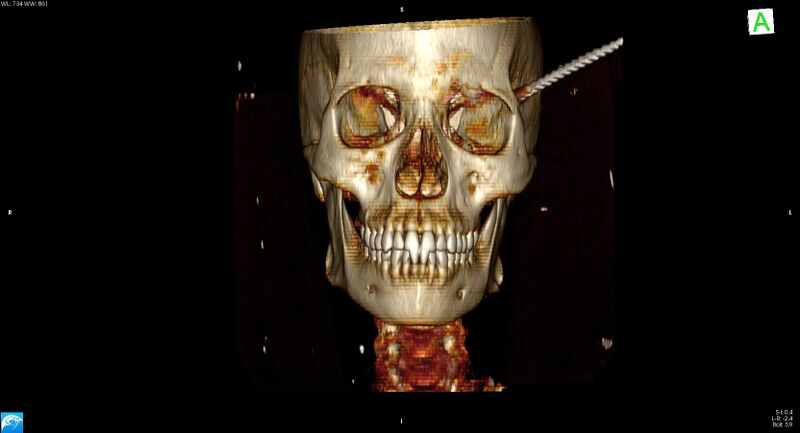 File:Arrow injury to the head (Radiopaedia 75266-86388 3D horizontal 1).jpg