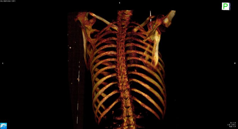 File:Arrow injury to the neck (Radiopaedia 75225-86323 3D bone 23).jpg