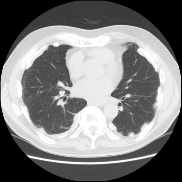 File:Asbestos-related pleural plaques (Radiopaedia 39069-41255 Axial lung window 43).jpg