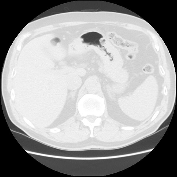 File:Asbestos-related pleural plaques (Radiopaedia 39069-41255 Axial lung window 70).jpg