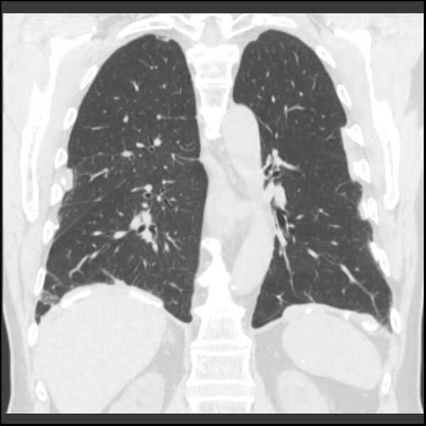 File:Asbestos-related pleural plaques (Radiopaedia 39069-41255 Coronal lung window 31).jpg