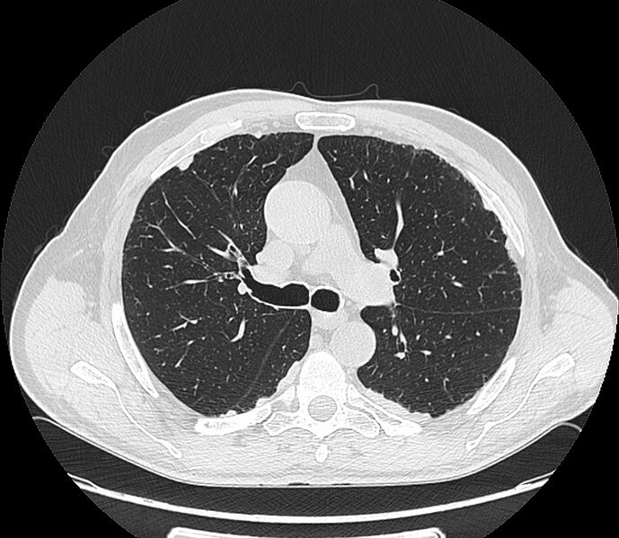File:Asbestos pleural placques (Radiopaedia 57905-64872 Axial lung window 101).jpg
