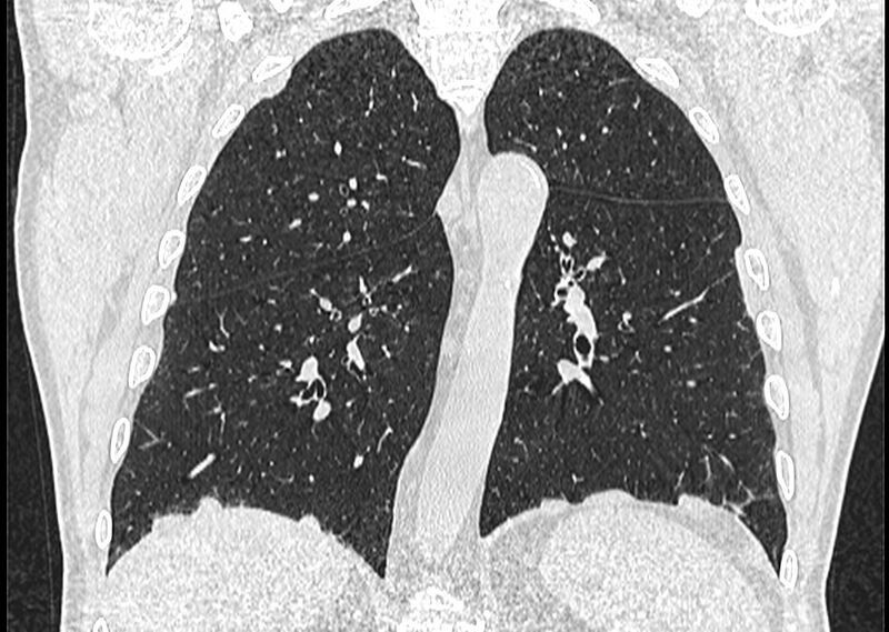 File:Asbestos pleural placques (Radiopaedia 57905-64872 Coronal lung window 188).jpg