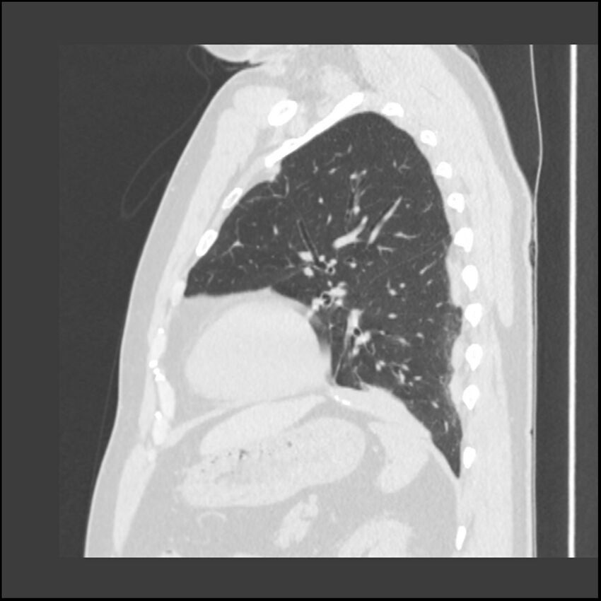 Asbestosis (Radiopaedia 45002-48961 Sagittal lung window 38).jpg