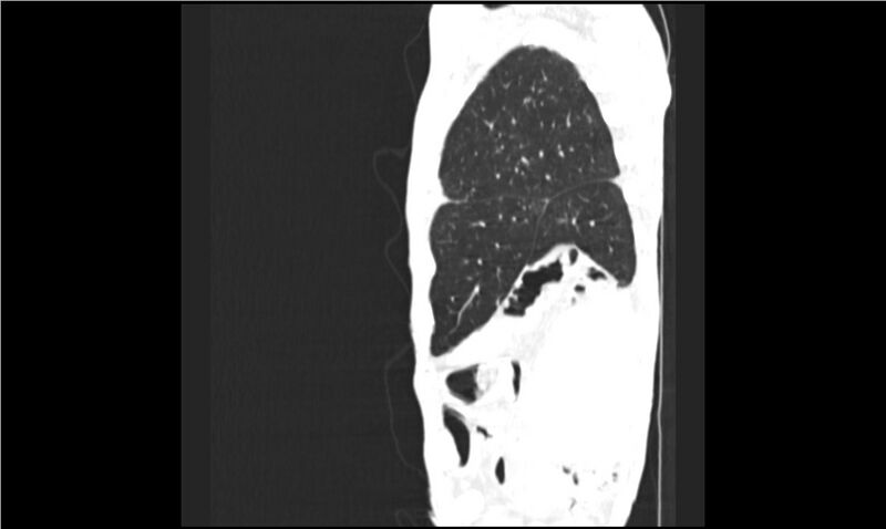 File:Aspergilloma (Radiopaedia 20788-20701 Sagittal lung window 18).jpg