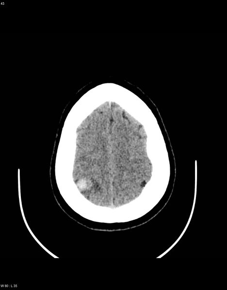 File:Astroblastoma (Radiopaedia 39792-42216 Axial non-contrast 42).jpg
