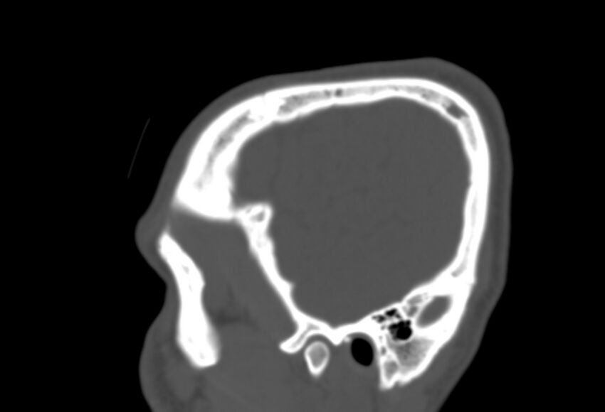 Asymptomatic occipital spur (Radiopaedia 87753-104201 Sagittal bone window 28).jpg