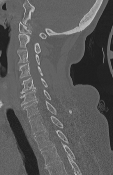 File:Atlanto-axial subluxation (Radiopaedia 36610-38176 Sagittal bone window 47).png