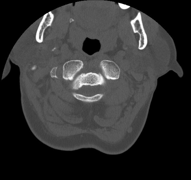 File:Atlanto-occipital assimilation with basilar invagination (Radiopaedia 70122-80188 Axial bone window 26).jpg